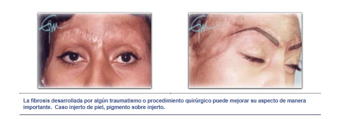 Fibrosis