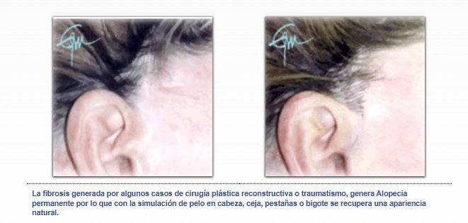 Alopecia