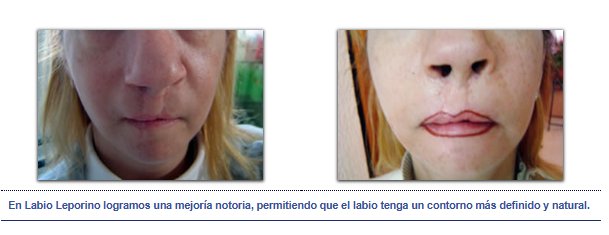 Labio leporino